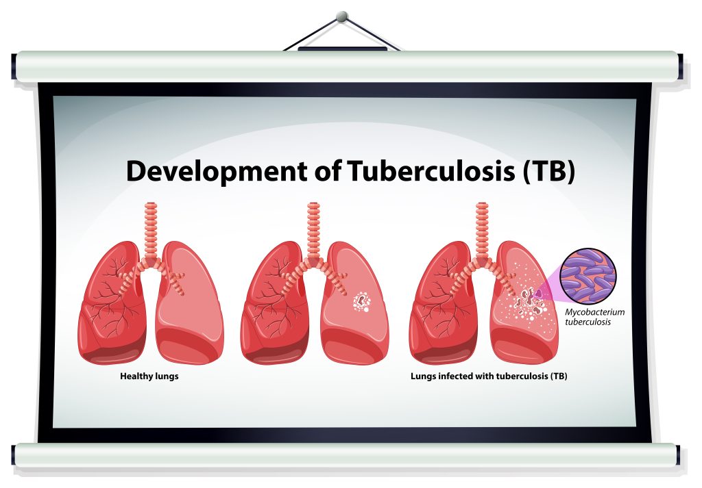 Tubercolosis